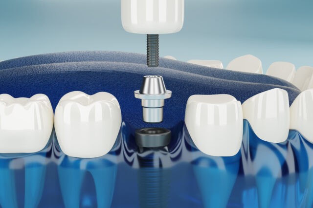 Impianti dentali a carico immediato